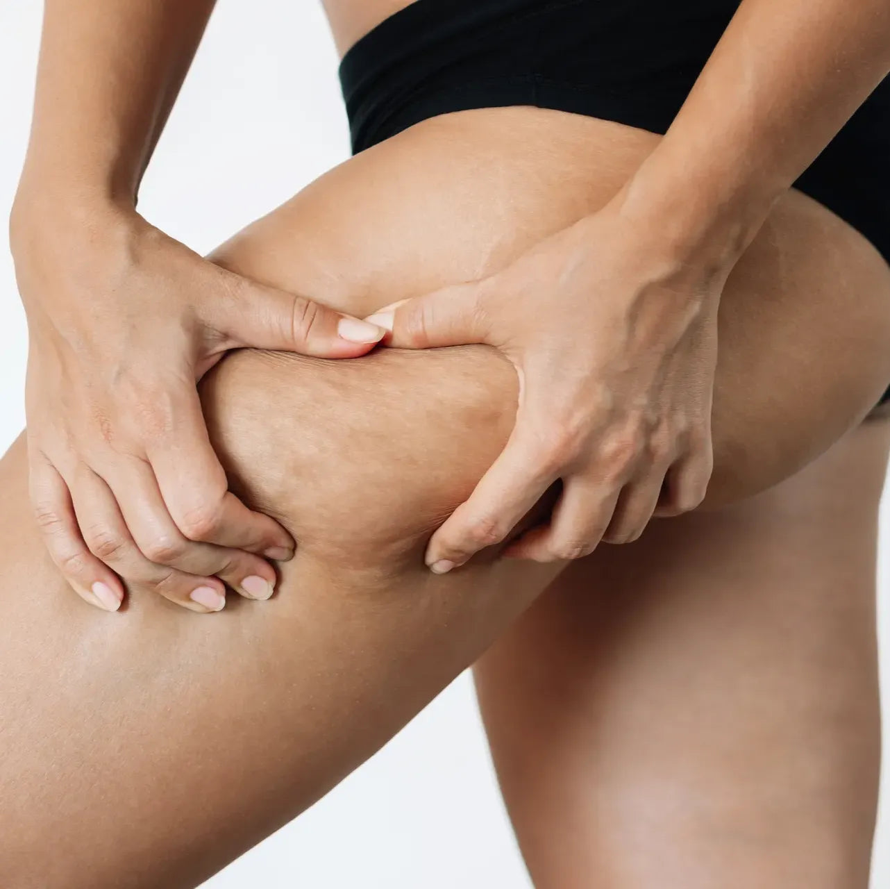 Celulite e Lipedema